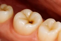 How Do Dentists Fix Cavities? Step-by-Step Fillings in Milpitas
