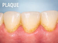 What’s the Difference Between Plaque and Tartar? (And How to Stop Both)