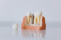 Dental Implants in Milpitas: Who Is a Good Candidate?